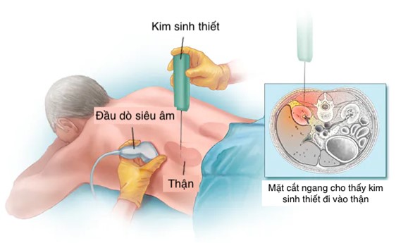 Sinh thiết